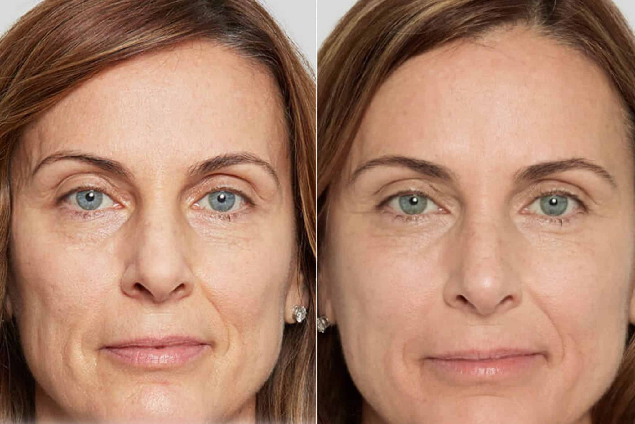 Antes — facial global